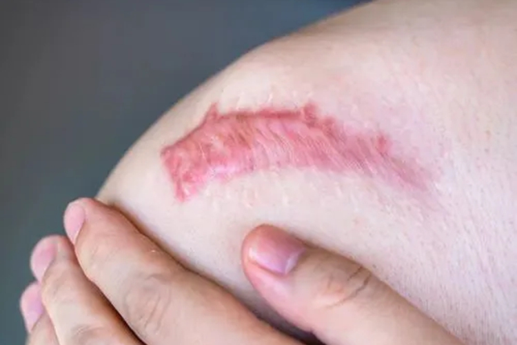 增生性瘢痕图 增生性瘢痕图