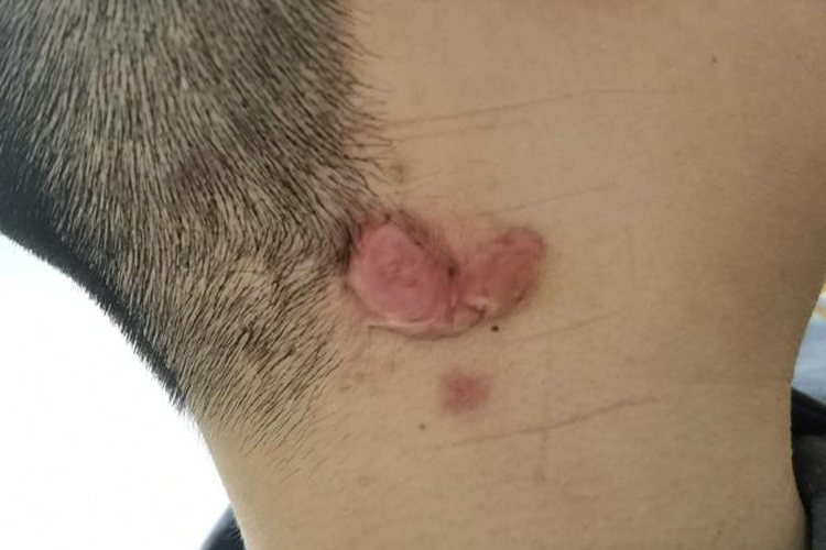 脖子烫伤瘢痕疙瘩图 脖子烫伤瘢痕疙瘩图