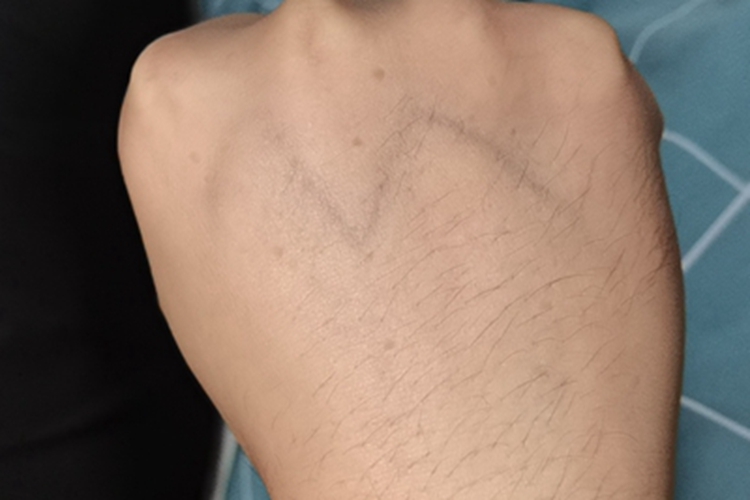 扁平疣手背上有浅褐色斑图