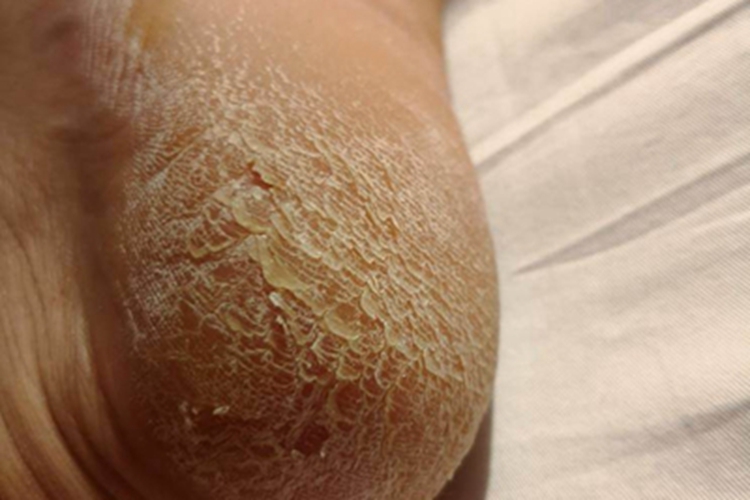 更年期角皮症脚后跟皮肤增厚图