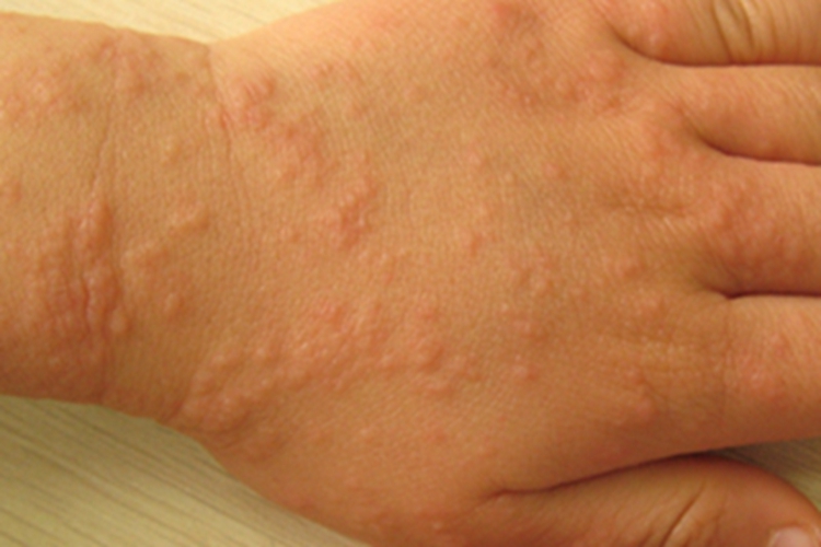 小儿丘疹性肢端皮炎手背小疙瘩图 小儿丘疹性肢端皮炎手背小疙瘩图