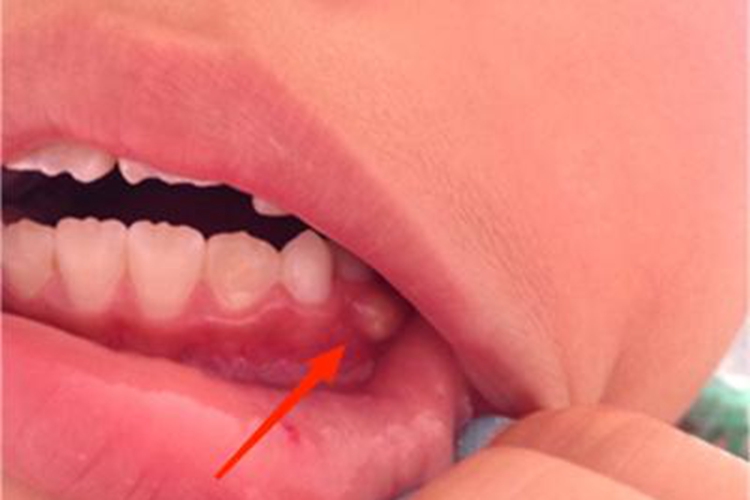 牙龈炎牙龈有个包图 牙龈炎牙龈有个包图