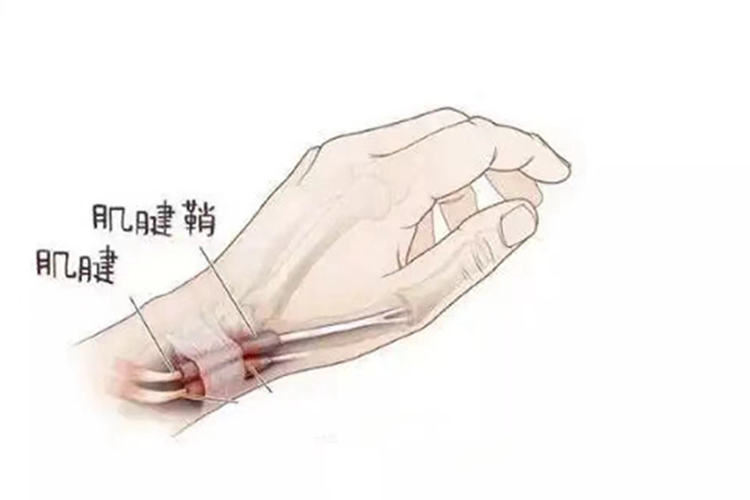 手腕桡侧的桡骨茎突腱鞘位置图 手腕桡侧的桡骨茎突腱鞘位置图