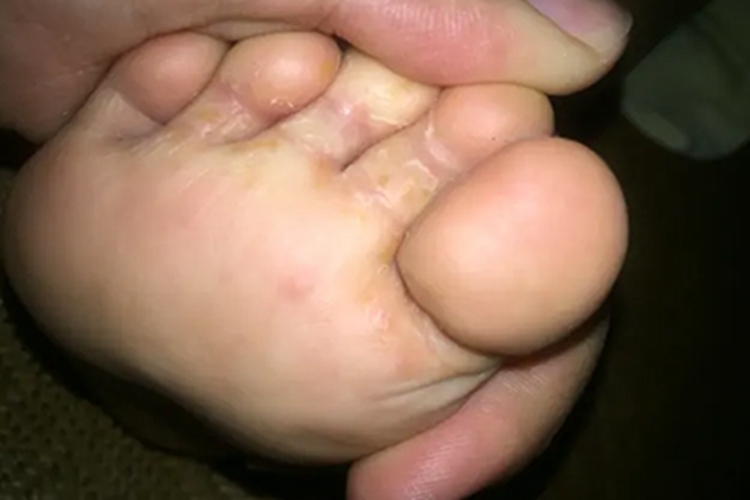 宝宝鳞屑角化型足癣图 宝宝鳞屑角化型足癣图