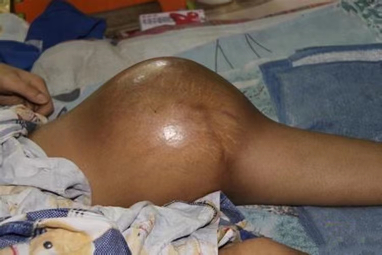 骨肉瘤大腿症状图