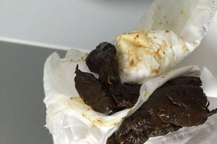 饮食引起黑便图