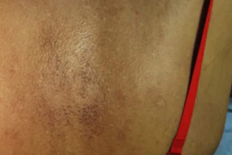 皮肤黑变病背部皮肤发黑图