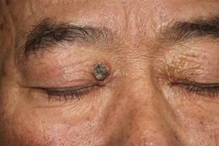 寻常疣眼周有黄豆大小疙瘩图