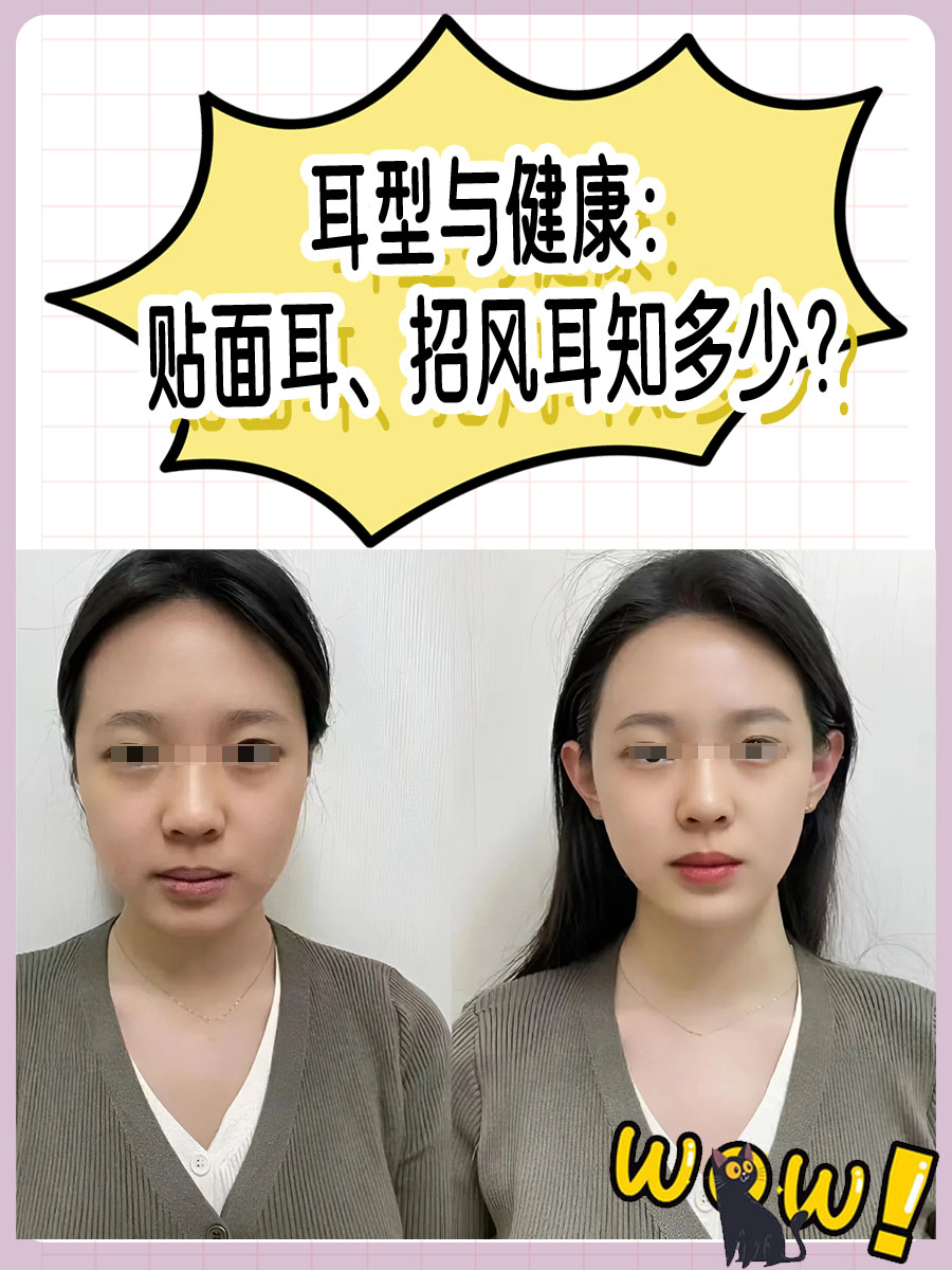 耳型与健康：贴面耳、招风耳知多少？