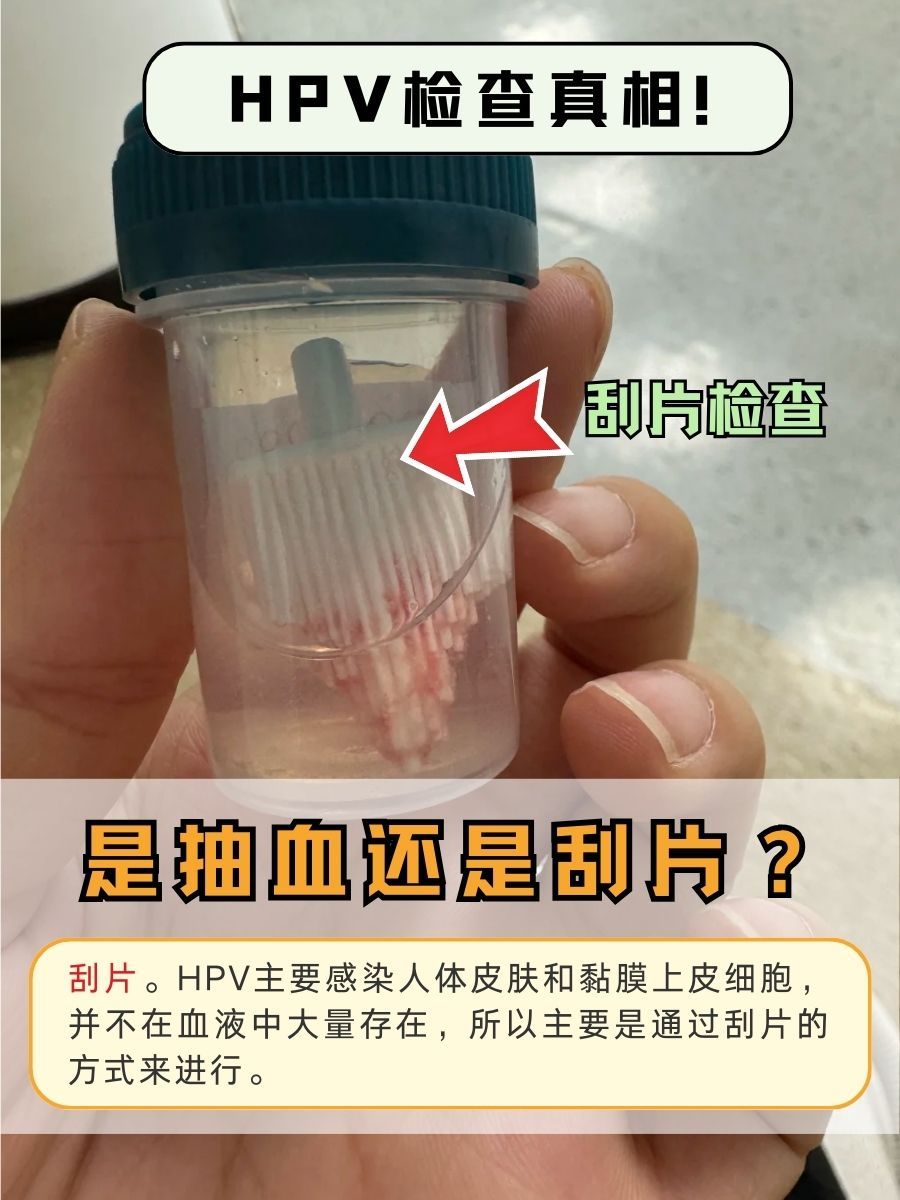HPV检查真相！是抽血还是刮片？