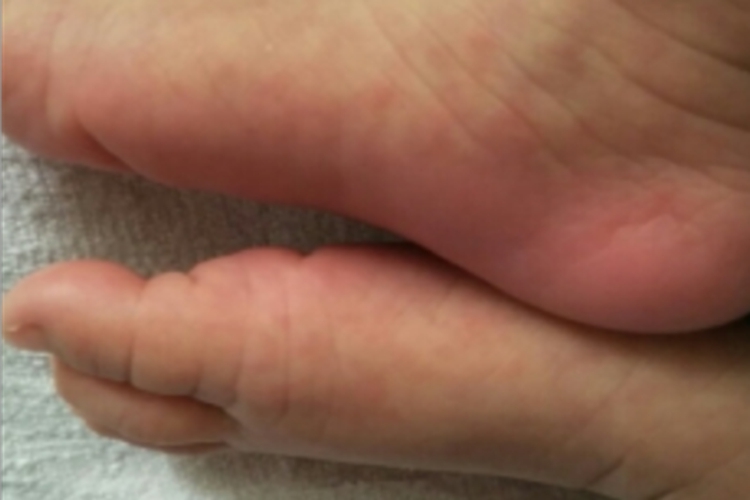 奶癣脚上弥漫性发红图