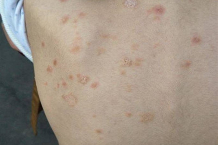 玫瑰糠疹背部长红斑脱屑图