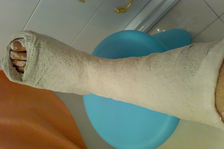 跟骨骨折打石膏图 跟骨骨折打石膏图