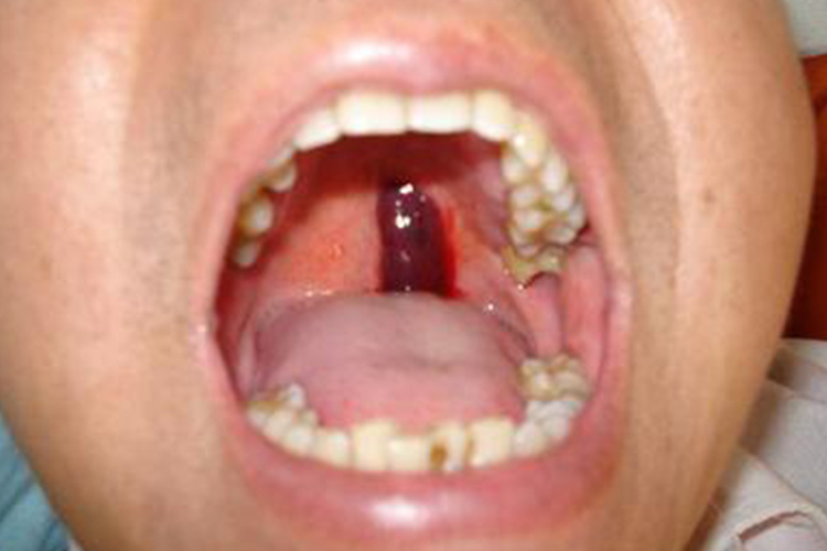 成人毛细血管瘤图