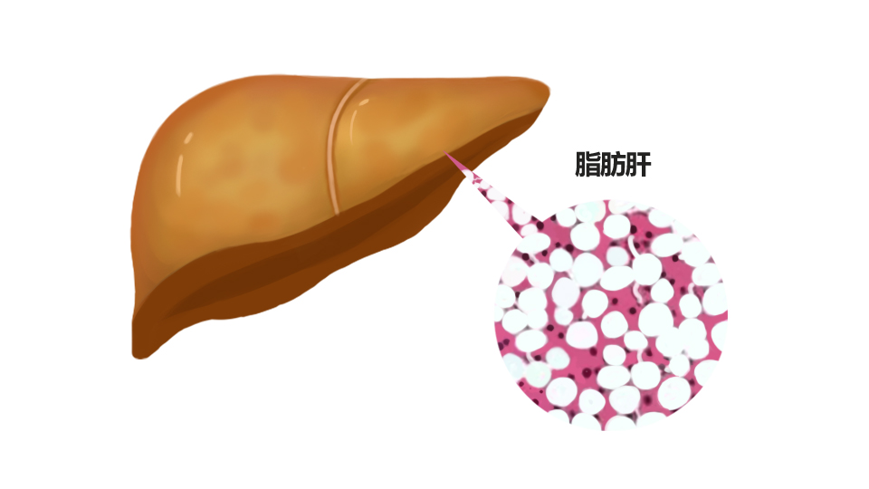 脂肪肝图