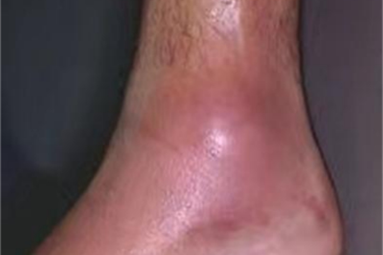 中度扭伤脚踝红肿图