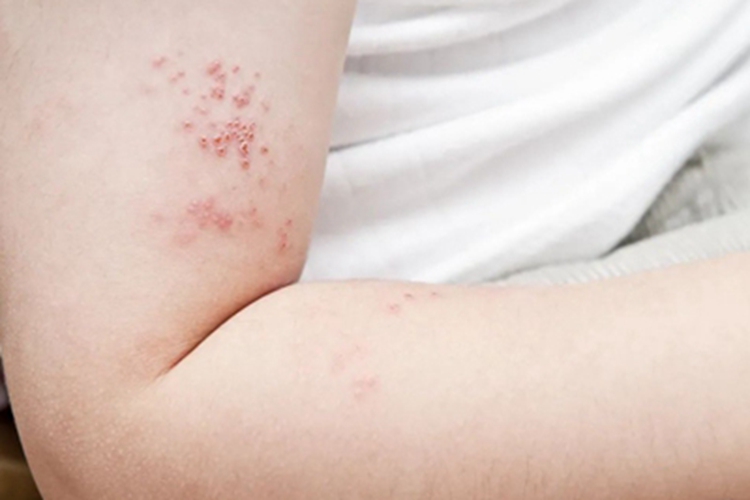 带状疱疹胳膊上长小水疱图