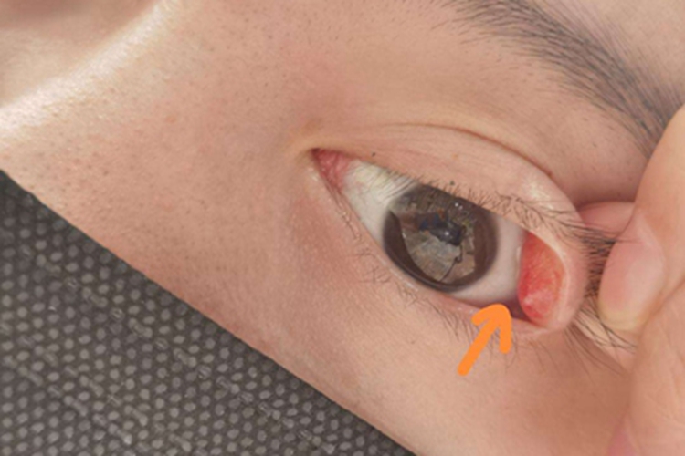 过敏性眼睑皮肤炎小红疙瘩图