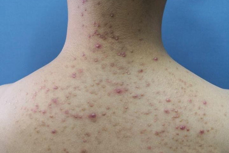背部痤疮炎症丘疹图
