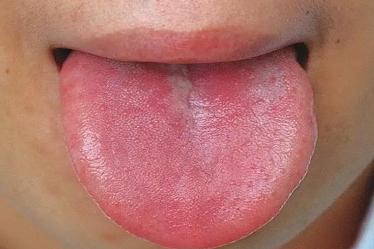 肝肾阴虚证舌头图