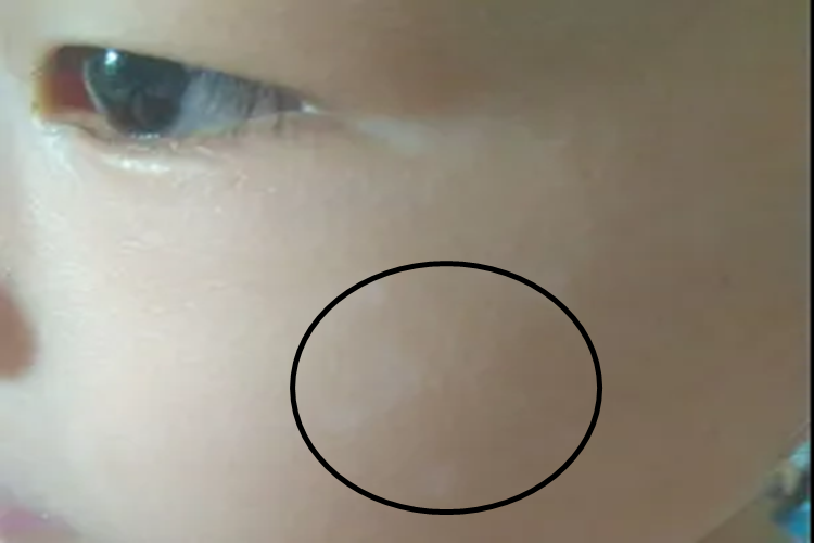 婴儿脸部白色胎记图 婴儿脸部白色胎记图