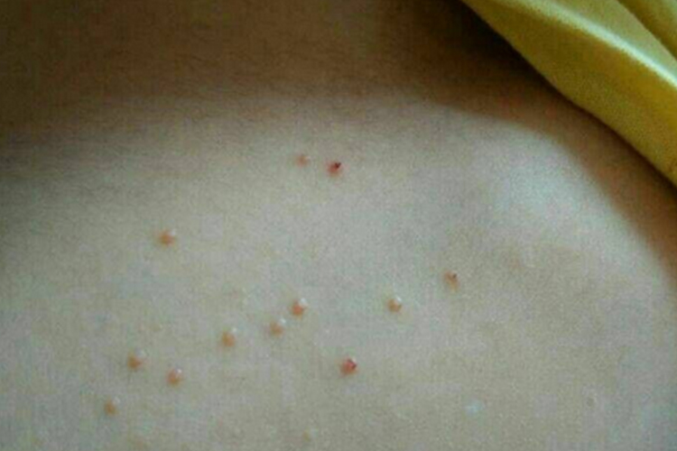 男性传染性软疣丘疹图