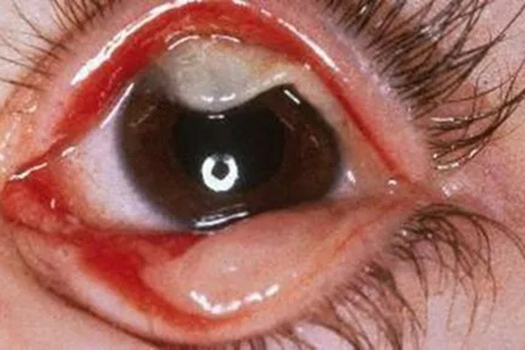 结膜乳头状瘤眼睑疙瘩图