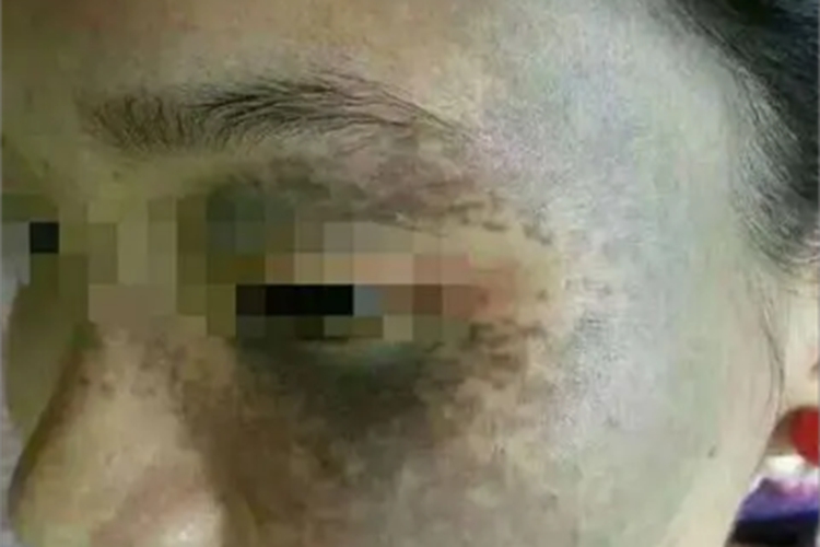 太田痣面部斑图