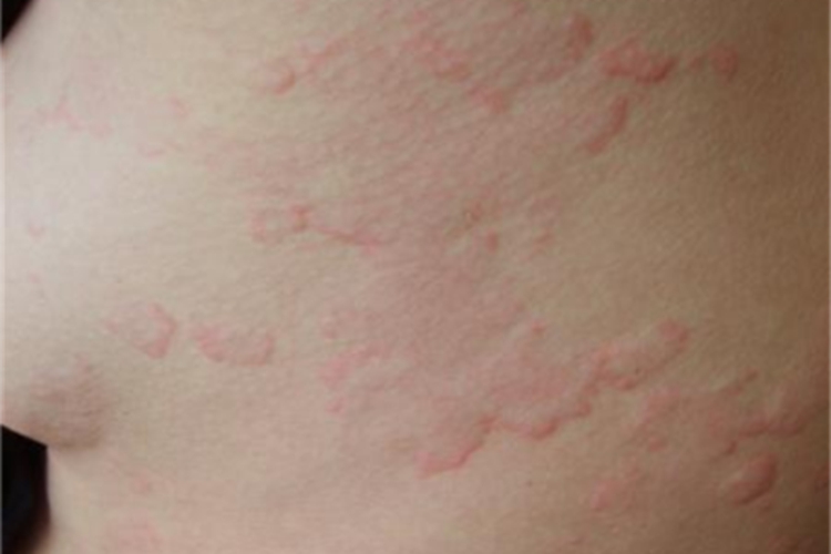 感染性荨麻疹胸部症状图 感染性荨麻疹胸部症状图