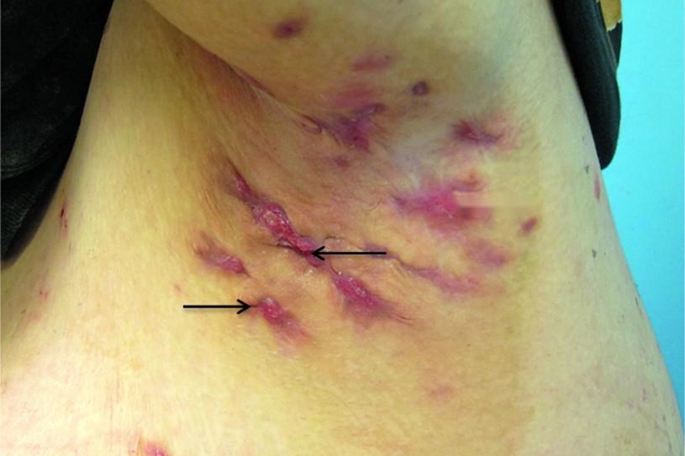 化脓性汗腺炎瘢痕图 化脓性汗腺炎瘢痕图