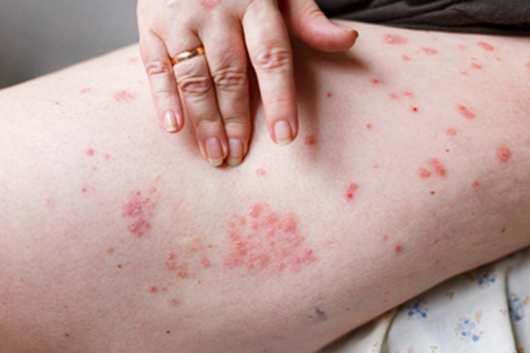 特应性皮炎大腿小红疙瘩图