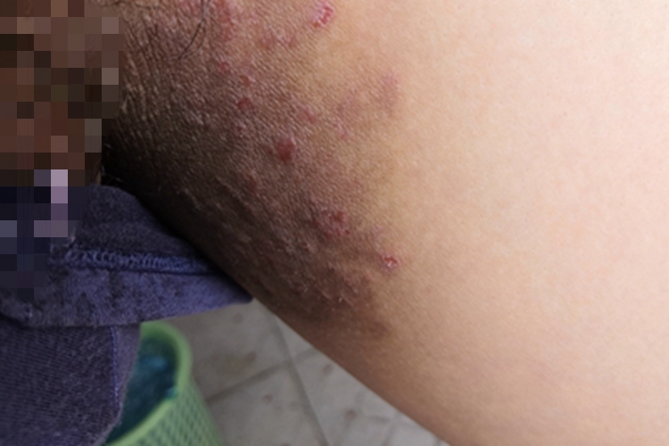 股癣大腿皮肤发黑图 股癣大腿皮肤发黑图