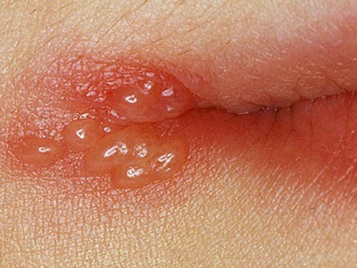 水痘会长在嘴唇上图片图片