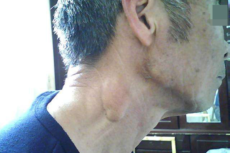 脖子脂肪瘤晚期图