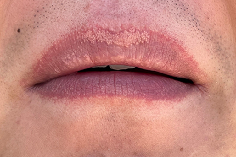 皮脂腺异位症嘴唇丘疹图