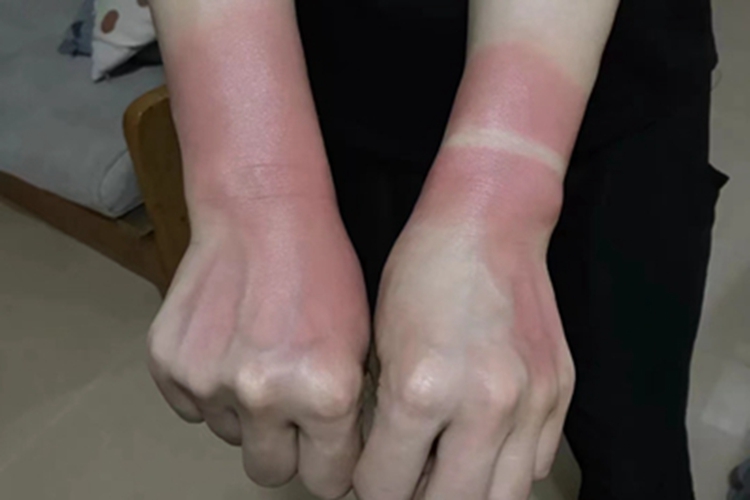 日晒伤手腕红斑图 日晒伤手腕红斑图