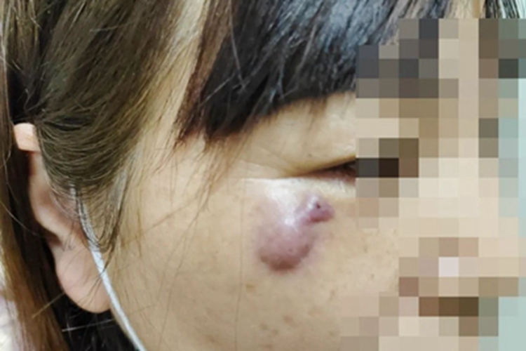 龟分枝杆菌皮肤感染面部症状图 龟分枝杆菌皮肤感染面部症状图