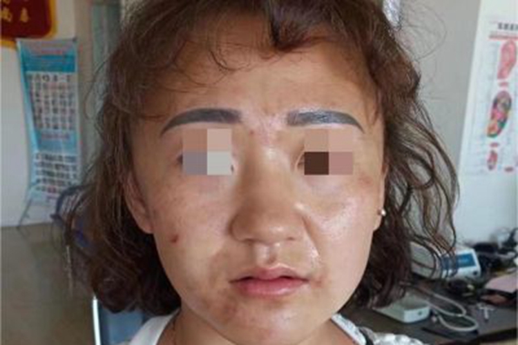 痤疮脸上有很多褐色斑片图