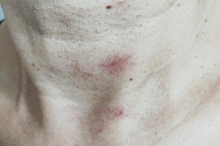 蜘蛛痣颈部症状图 蜘蛛痣颈部症状图