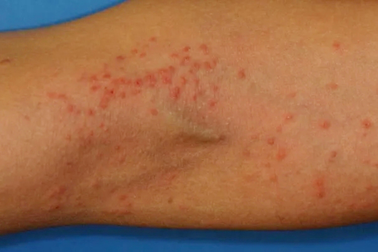 手臂湿疹图 手臂湿疹图