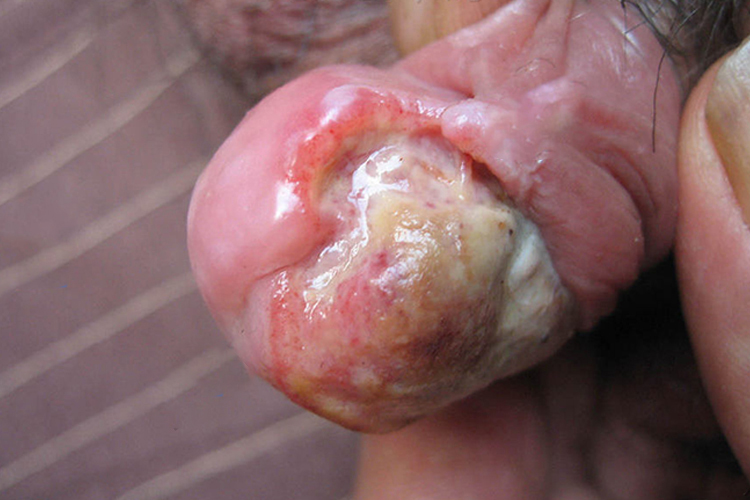 硬斑病样型基底细胞癌图 硬斑病样型基底细胞癌图