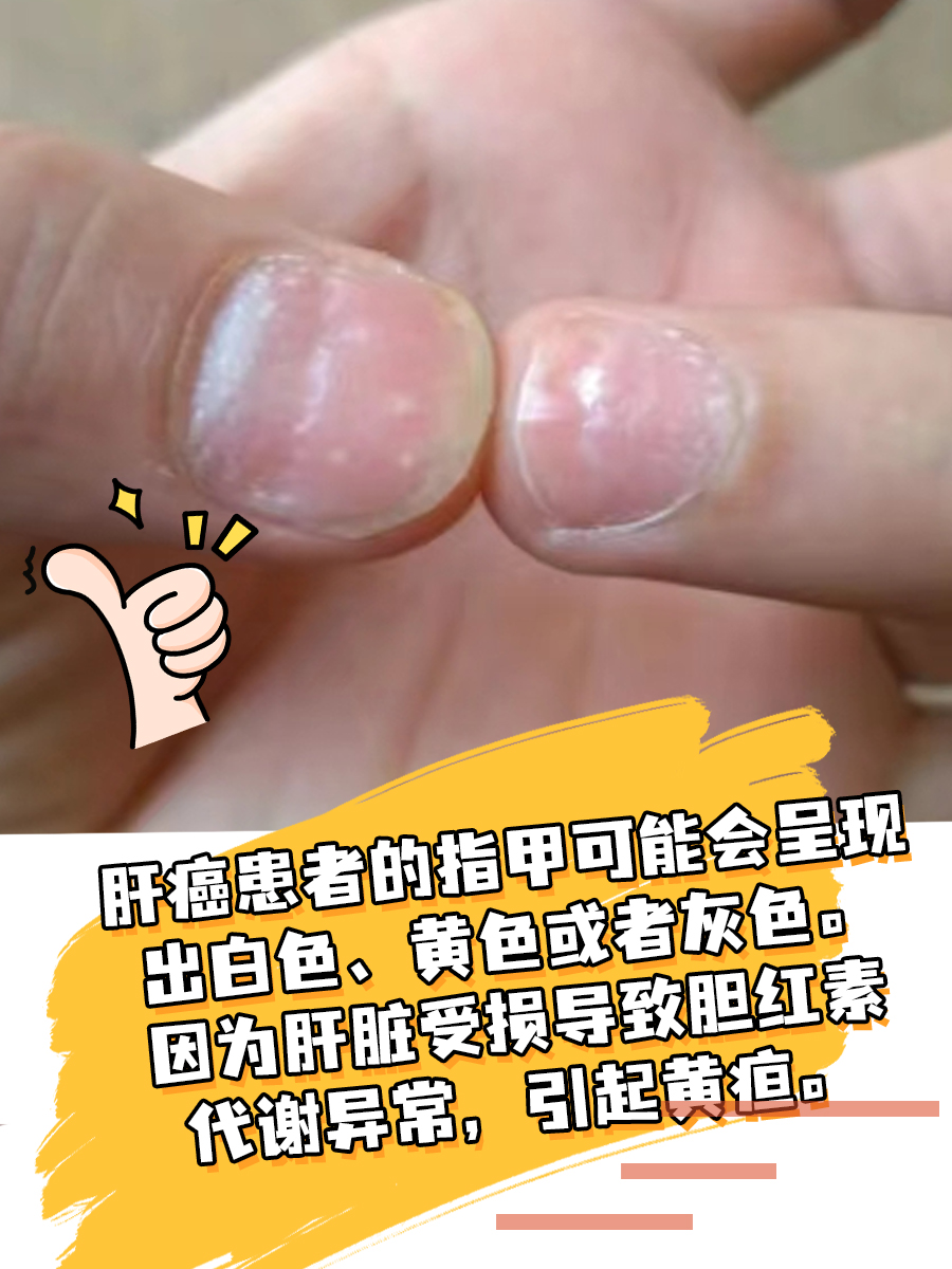 身体有肝癌，指甲先知！