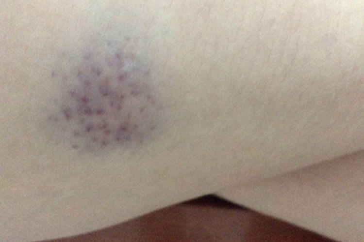 外伤皮下瘀斑图