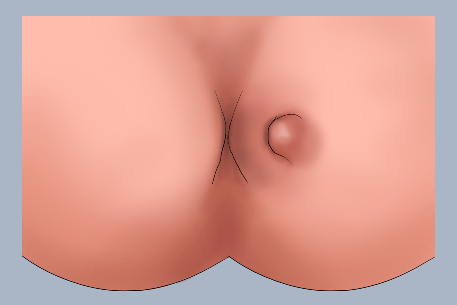 婴儿肛瘘图 婴儿肛瘘图