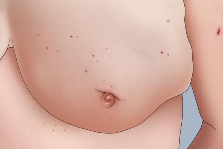 乳腺癌晚期肿块图