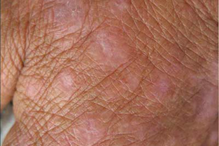 扁平苔藓样接触性皮炎手背斑图