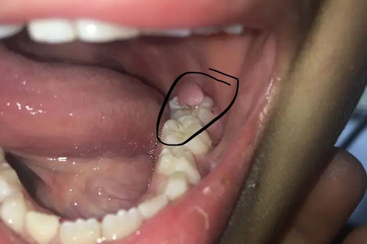 药物性牙龈增生图