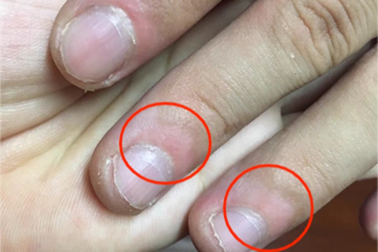 非节段型白癜风手指尖症状图