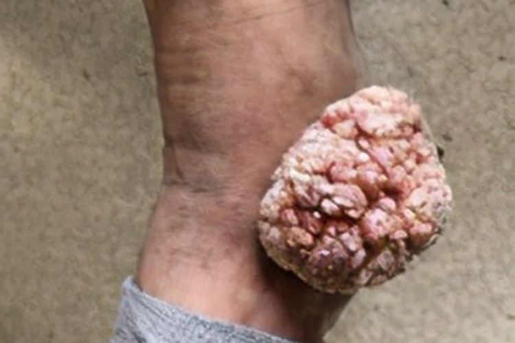 疣状癌脚踝肉球图