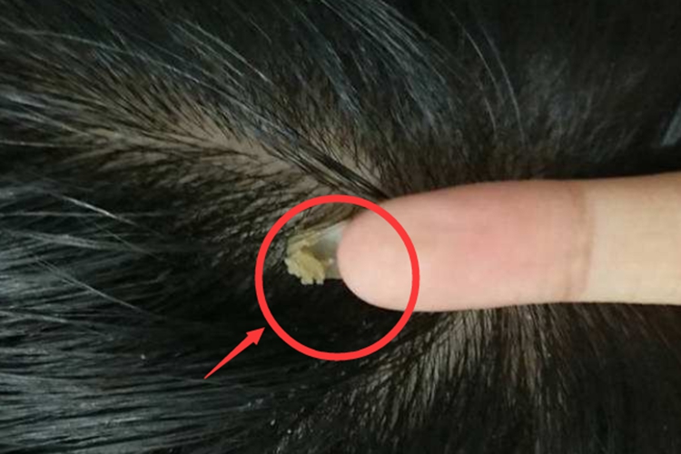 头皮抠出一粒黄结晶体图